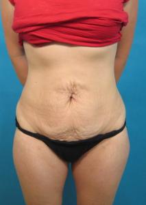 Patient before tummy tuck procedure